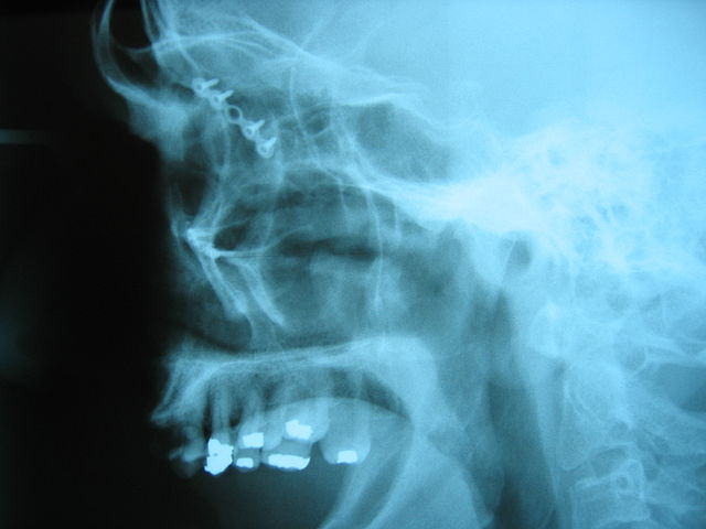 File:Lateralcephplated.JPG