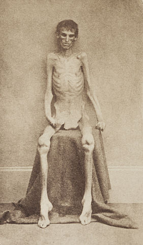 File:Andersonvillesurvivor.jpg