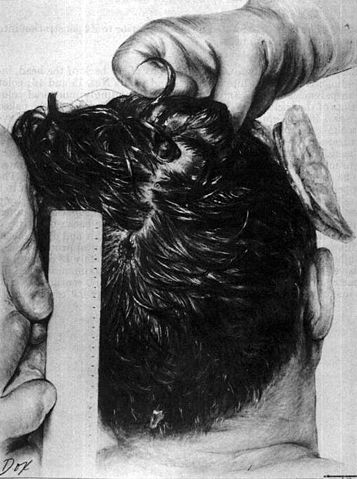 File:JFK posterior head wound.jpg
