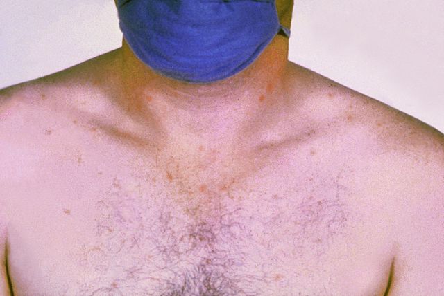 File:Salmonella typhi typhoid fever PHIL 2215 lores.jpg