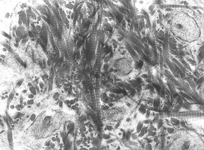 File:Woven bone matrix.jpg
