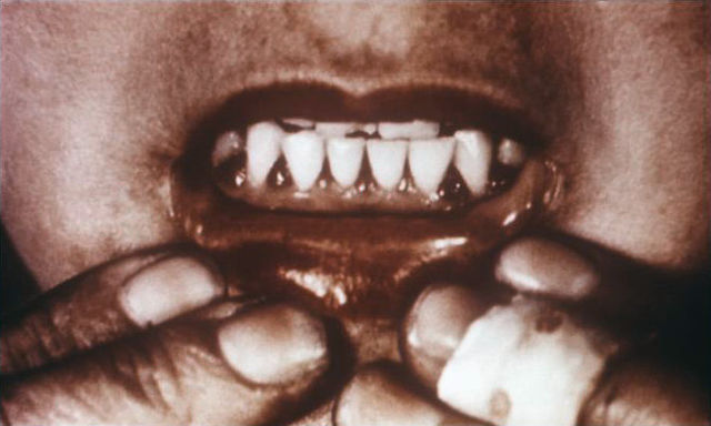 File:Scorbutic gums.jpg