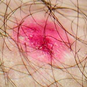 File:Eczema.jpg